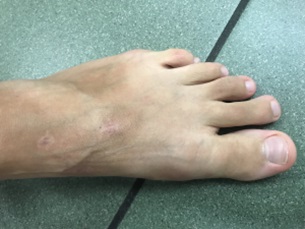 MIS Lapidus stopy lewej - efekty operacji palucha koślawego