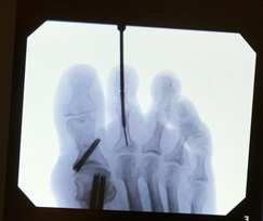 Zabieg artrodezy PIP - korekcja palców młotkowatych - podgląd fluoroskopowy